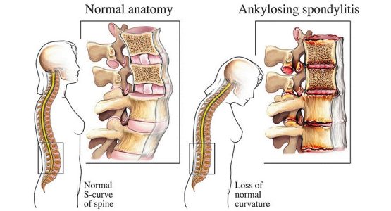 Ankylosing Spondylitis