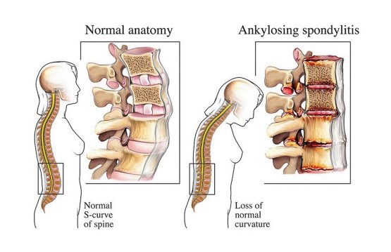 Ankylosing Spondylitis