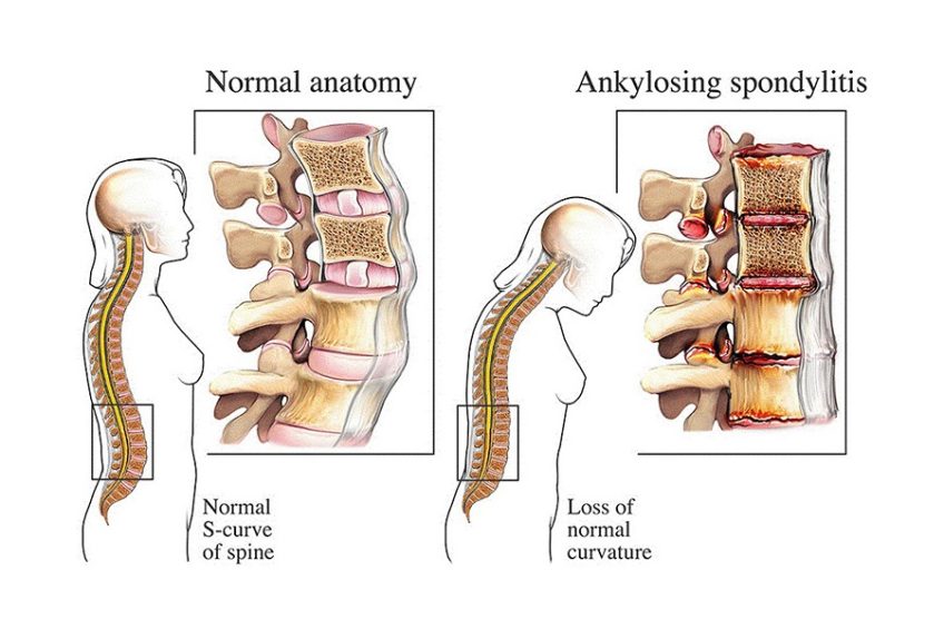 Ankylosing Spondylitis