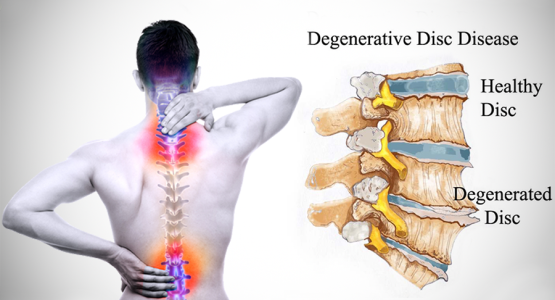 Degenerative-Disk-Disease-backpainsources.com