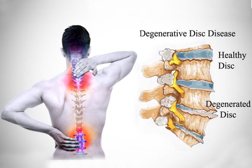 Degenerative-Disk-Disease-backpainsources.com