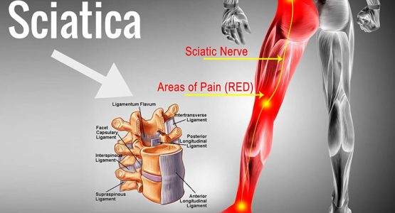 Sciatica