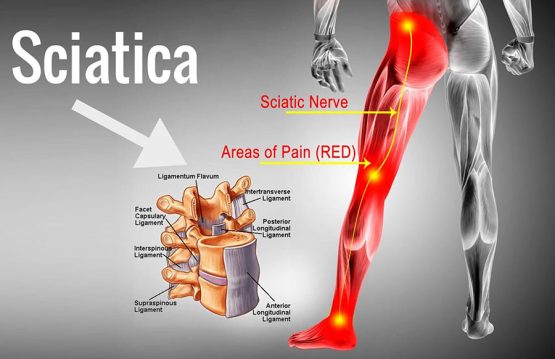 Sciatica