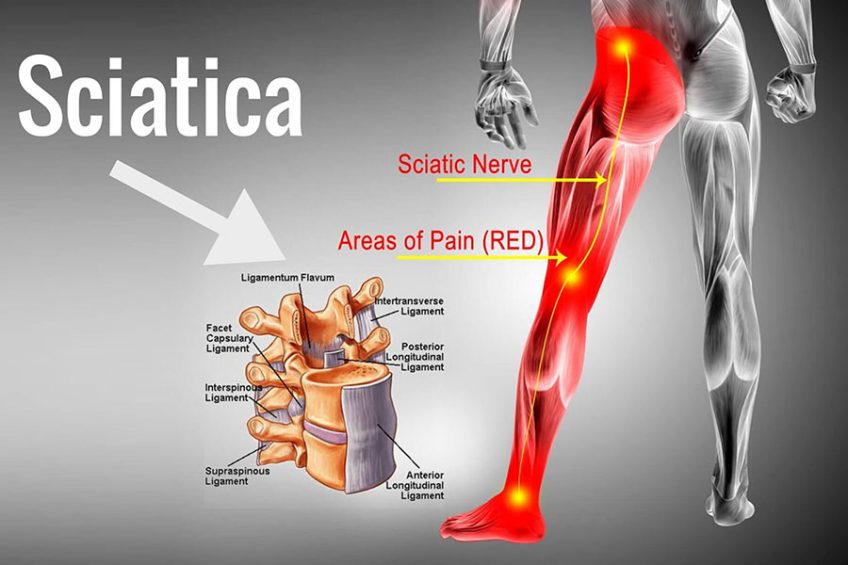 Sciatica