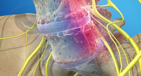 Spondylolisthesis