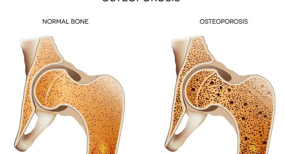 osteoporosis