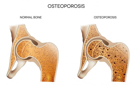 osteoporosis