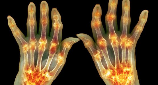 Rheumatoid-Arthritis