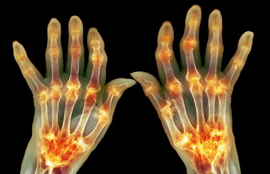 Rheumatoid-Arthritis