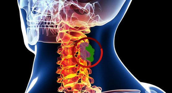 spinal-tumors