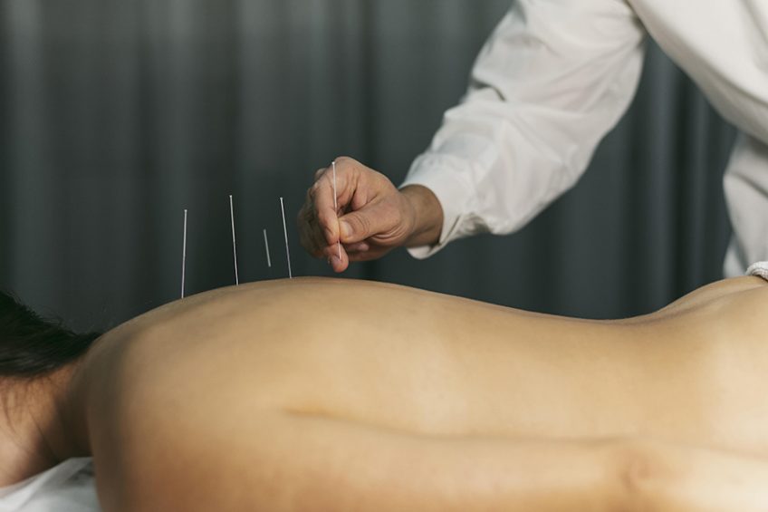 Acupuncture for the treatment of back pain