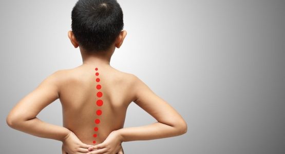 Kyphosis in children