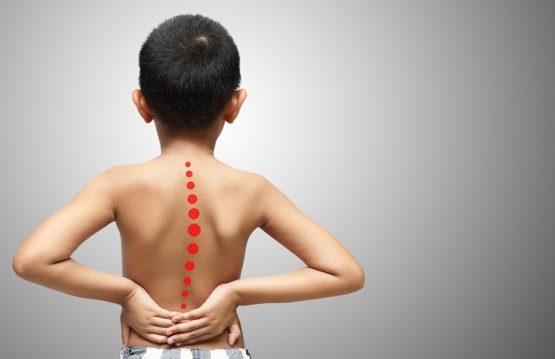 Kyphosis in children