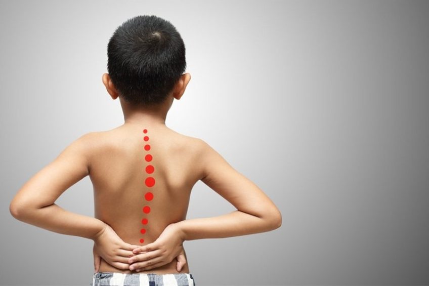 Kyphosis in children