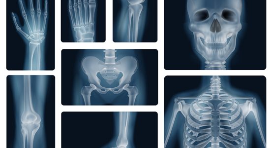 Osteogenesis Imperfecta - Brittle Bone Disease