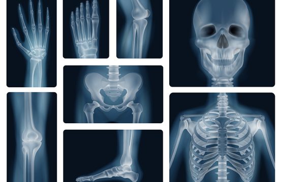 Osteogenesis Imperfecta - Brittle Bone Disease