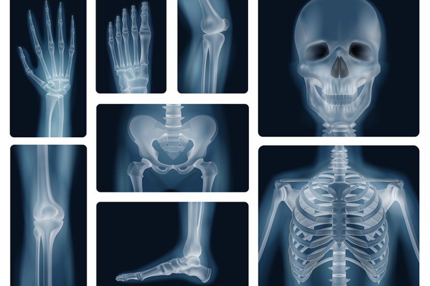 Osteogenesis Imperfecta - Brittle Bone Disease