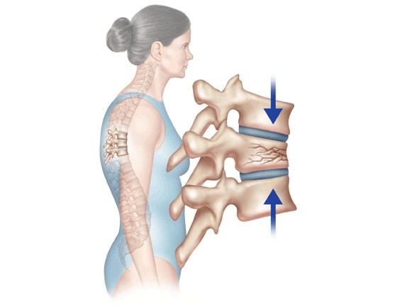 Compression Vertebral Fractures