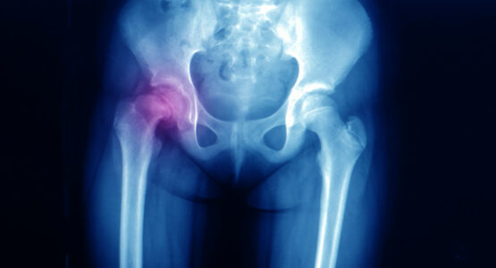 Coxa Vara Understanding the Causes, Diagnosis, and Therapeutic Options for Hip Deformity