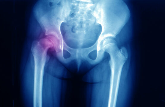 Coxa Vara Understanding the Causes, Diagnosis, and Therapeutic Options for Hip Deformity