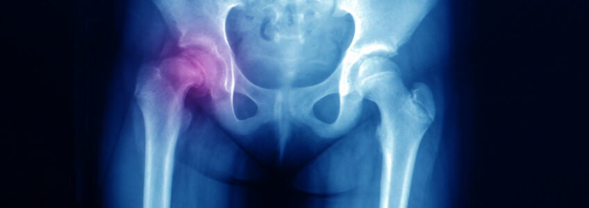 Coxa Vara Understanding the Causes, Diagnosis, and Therapeutic Options for Hip Deformity