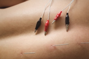 Electroacupuncture