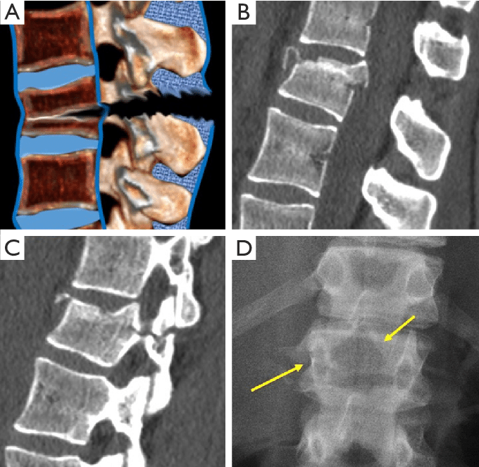 Flexion fractures