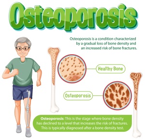 Preventing Osteoporosis Caring for Your Bone Health