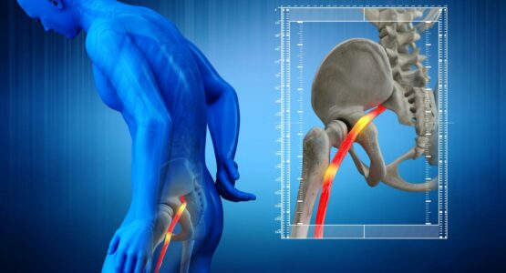 Remedies for sciatic nerve pain