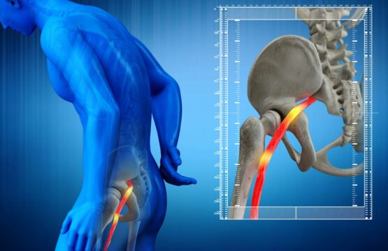 Remedies for sciatic nerve pain