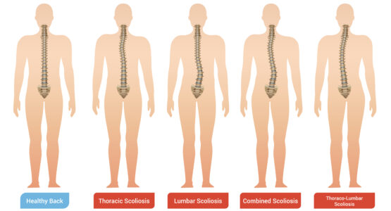 Scoliosis in adults 5 things you didn't know about it