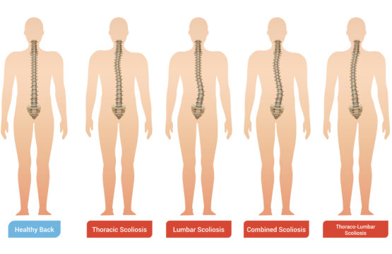 Scoliosis in adults 5 things you didn't know about it