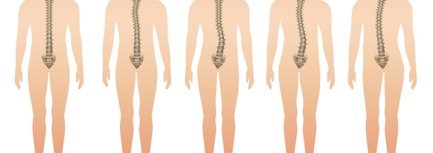 Scoliosis in adults 5 things you didn't know about it