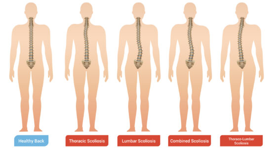 Scoliosis in adults 5 things you didn't know about it