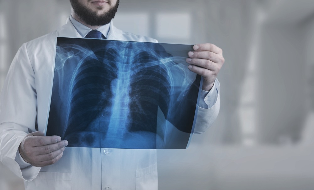 Settlement Vertebral Fractures