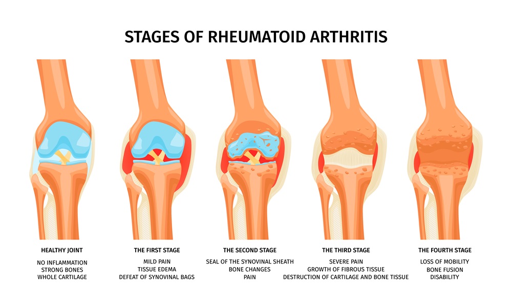 Systemic complications