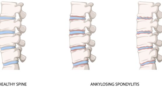 Tests for Ankylosing Spondylitis How to Detect It