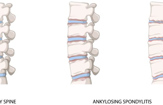 Tests for Ankylosing Spondylitis How to Detect It