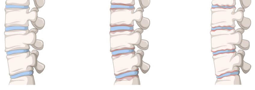 Tests for Ankylosing Spondylitis How to Detect It