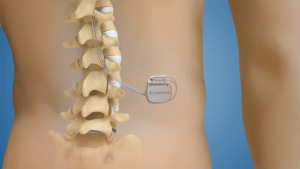 Treatment of Back Pain: Innovative Methods in Modern Medicine