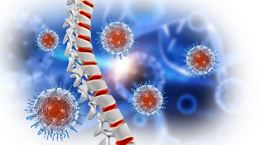 Types of Spinal Tumors