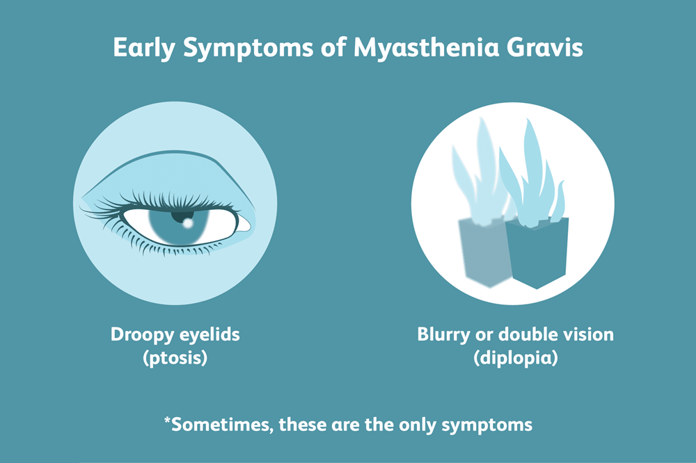 Myasthenia gravis symptoms
